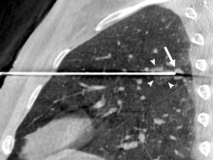 Biópsia pulmonar aspirativa percutânea