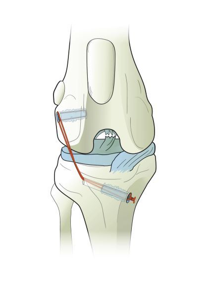 Âncoras Ti-Force de Rosca Completa usadas na reparação de ligamentos articulares