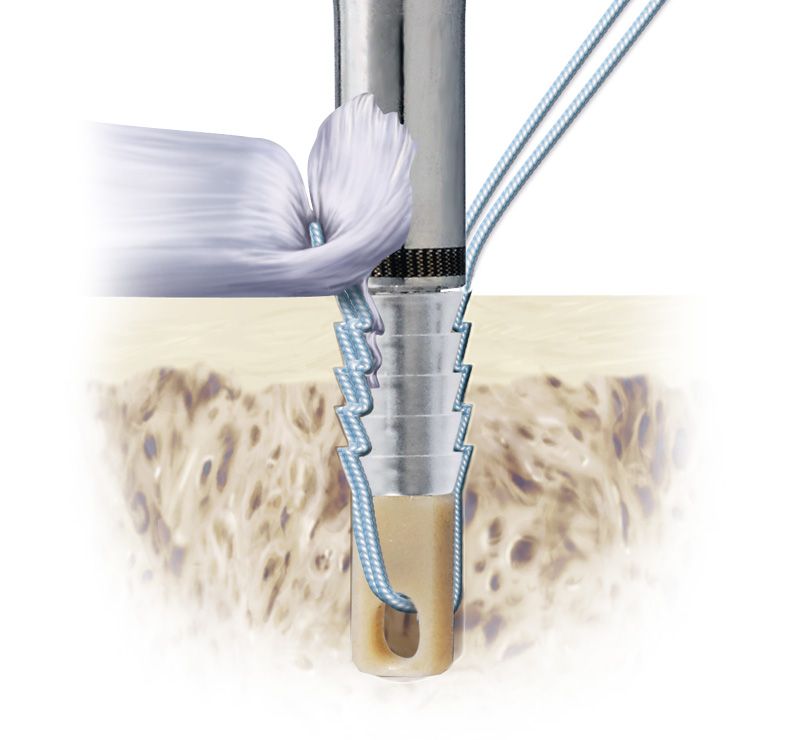  Âncora Flexível Bio-Force em cenários cirúrgicos