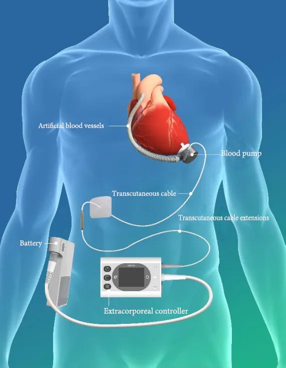 Esquemático do produto BrioVAD™ Sistema de Assistência Ventricular Esquerda