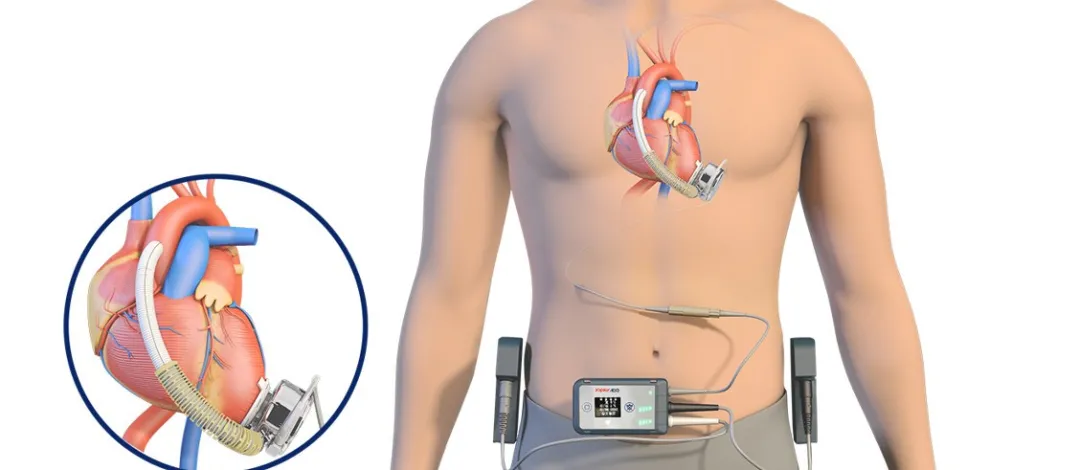  Sistema de Assistência Ventricular Esquerda Implantável CH® (CH-VAD)