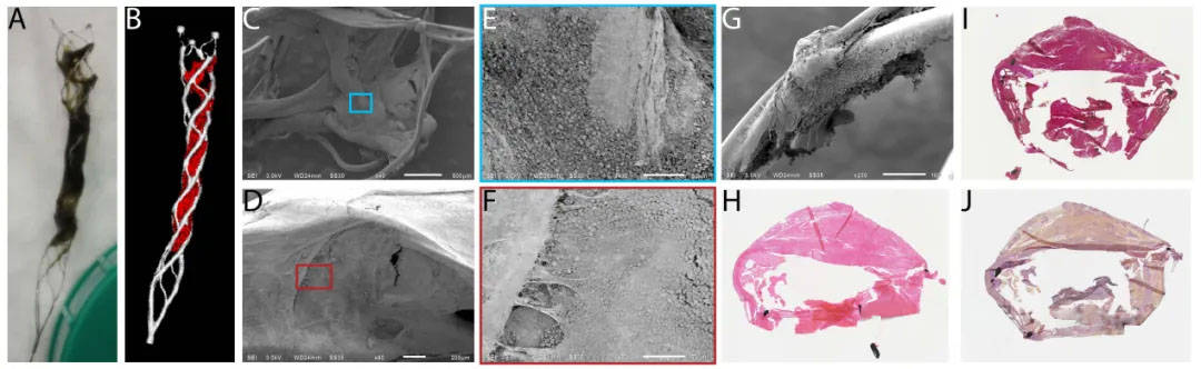 Imagem de Alta Resolução da Interação Entre Trombo e Stent-Retriever em Pacientes com Acidente Vascular Isquêmico Agudo