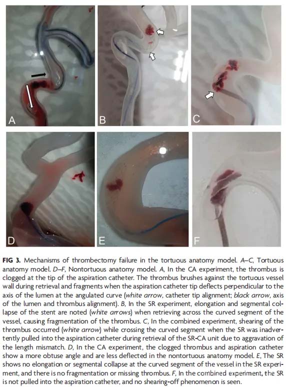 Análise In Vitro da Eficácia das Técnicas de Tromboectomia Endovascular de Acordo com a Tortuosidade Vascular Usando Modelos Impressos em 3D