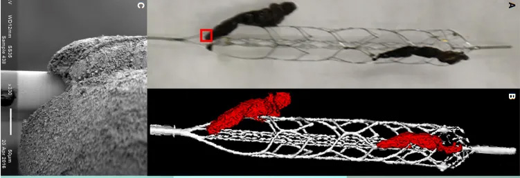 Imagem de Alta Resolução da Interação Entre Trombo e Stent-Retriever em Pacientes com Acidente Vascular Isquêmico Agudo