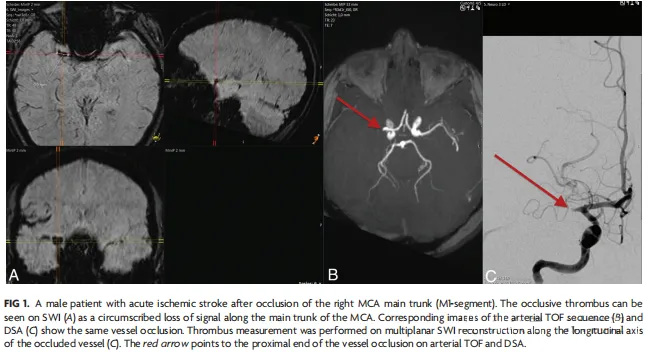 Riscos do Comprimento do Stent Retriever Inferior ao Comprimento do Trombo em Pacientes com Acidente Vascular Isquêmico Agudo